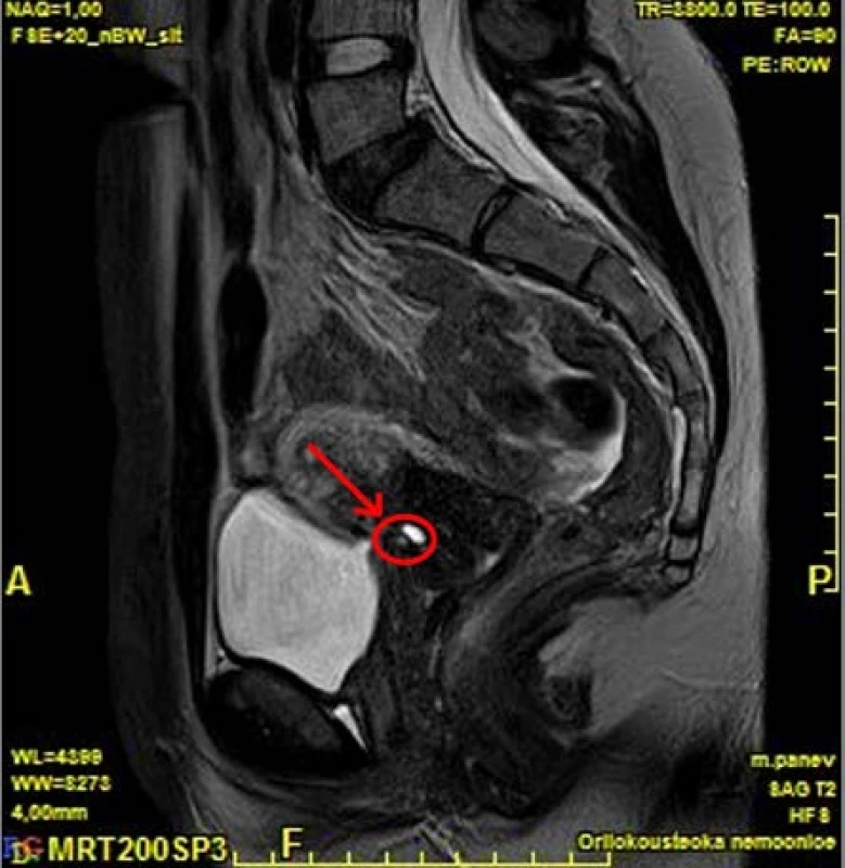 MR, sagitální řez, T2: cystický útvar mezi děložním
hrdlem a zadní stěnou močového měchýře ve
střední čáře<br>
Fig. 3. MR, sagittal plane, T2: cystic form between the
cervix and the back wall of the bladder in the midline