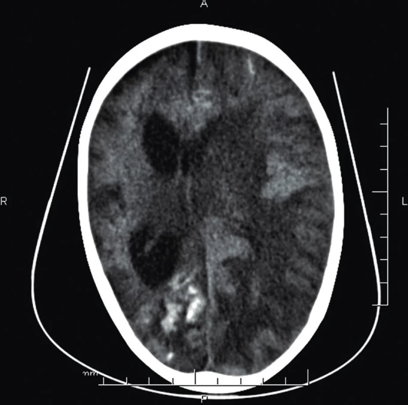 CT mozgu (2 r. 4 mes.) – stav po ischémii pravej mozgovej
hemisféry vo vývoji s prechodom do malácie.
Difúzne akútne ischemické zmeny ľavej mozgovej
hemisféry s jej edémom a presunom stredočiarových
štruktúr.<br>
Fig. 3. Brain CT (age 2 years 4 months) – post ischaemic lessions
of the right brain hemisphere, with development
in encephalomalacia. Acute left hemisphere ischemic
changes with edema with midline shift.