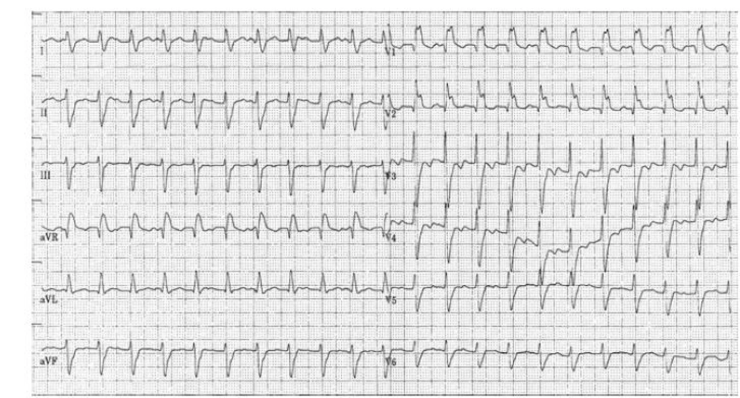 Kvízová EKG křivka<br>
Popis EKG křivky je uveden v textu