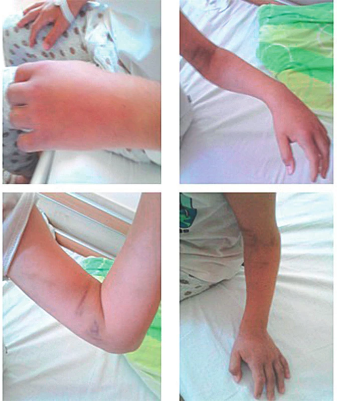 10-ročný chlapec po envenomácii do palca ľavej hornej
končatiny.
A – Lokálny opuch ruky. B – Lokálny opuch s miernou
hemorágiou bez hematologických abnormalít.
C – Progresia edému na celú ľavú hornú končatinu
až do axily, bez neurocirkulačnej poruchy (USG). D –
Regresia edému na 6. deň symptomatickej liečby.<br>
Fig. 5. 10-year-old boy after envenomation to the left upper
limb.
A – Local swelling of the hand. B – Local swelling with
mild haemorrhage without haematological abnormalities.
C – Edema progression to the entire left upper
limb up to the axilla, without neurocirculatory disorder
(USG ). D – Regression of edema on the 6th day of
symptomatic treatment.