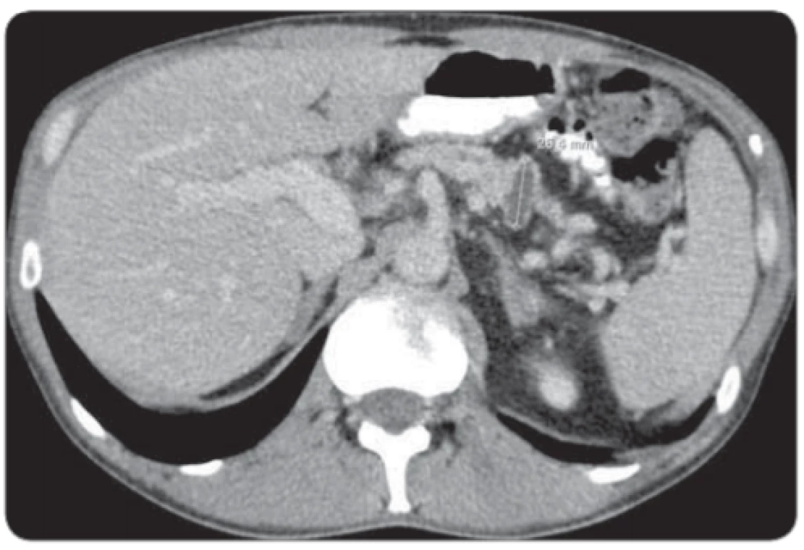 A. Vstupné CT vyšetrenie zobrazujúce lokálne pokročilý
tumor tela pankreasu.