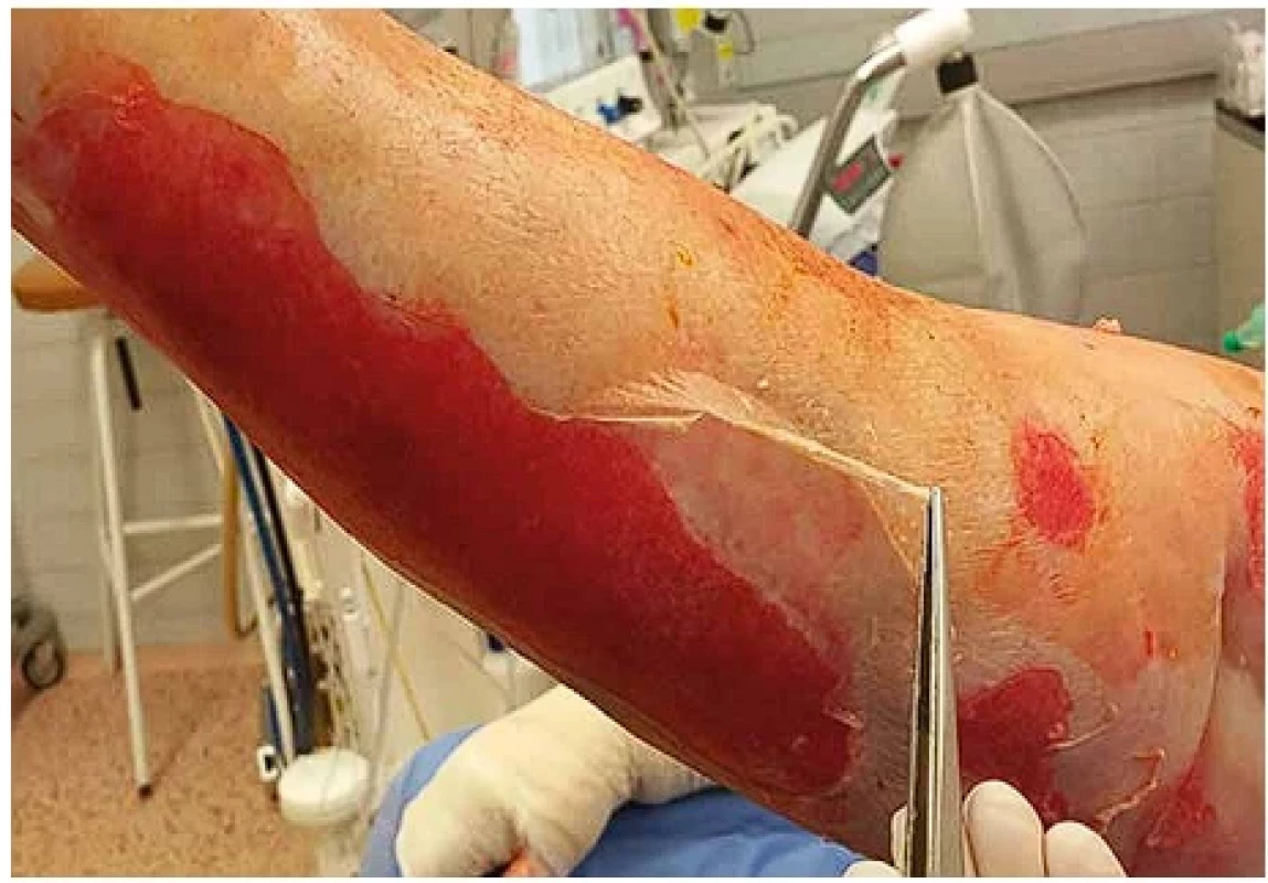  Toxická epidermální nekrolýza, kožní léze – klinický obraz.
