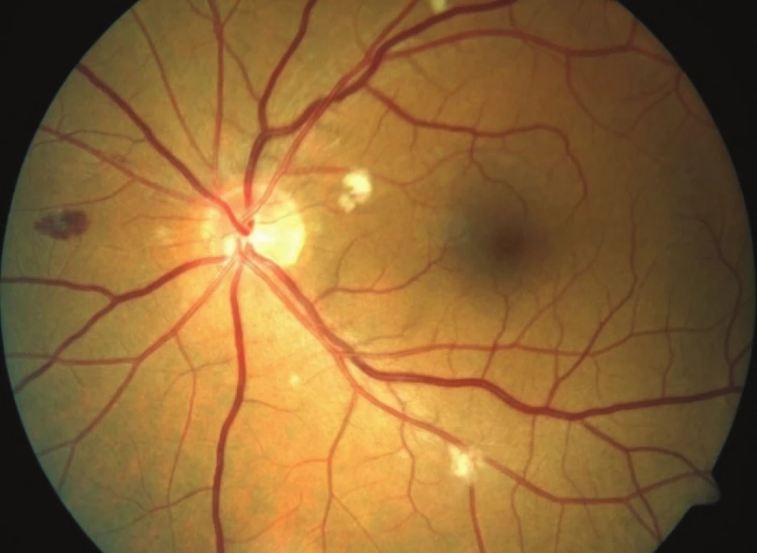 HIV microvasculopathy and retinopathy - haemorrhage, cotton
wool spots, small microaneurysms