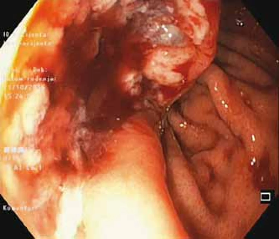 Endoscopic appearance of gastrointestinal
stromal tumor.