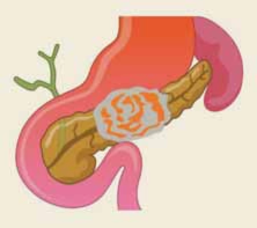 Akutní nekrotizující pankreatitida v oblasti těla pankreatu zahrnující hlavní pankreatický vývod
– ilustrace.<br>
Fig. 1. Acute necrotizing pancreatitis
in the body of the pancreas containing
the main pancreatic duct – an illustration.