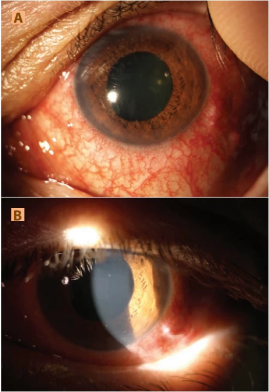 (A) Nález na předním segmentu levého oka v difuzním světle: smíšená injekce, prosáklá duhovka, širší, vertikálně
oválná, plegická zornice<br>
(B) Nález na předním segmentu levého oka v  šikmém světelném řezu: mírné zašednutí rohovky, nálet bělavých hmot na
endotelu rohovky, přiměřeně hluboká přední komora s přítomností pohybujících se bělavých hmot