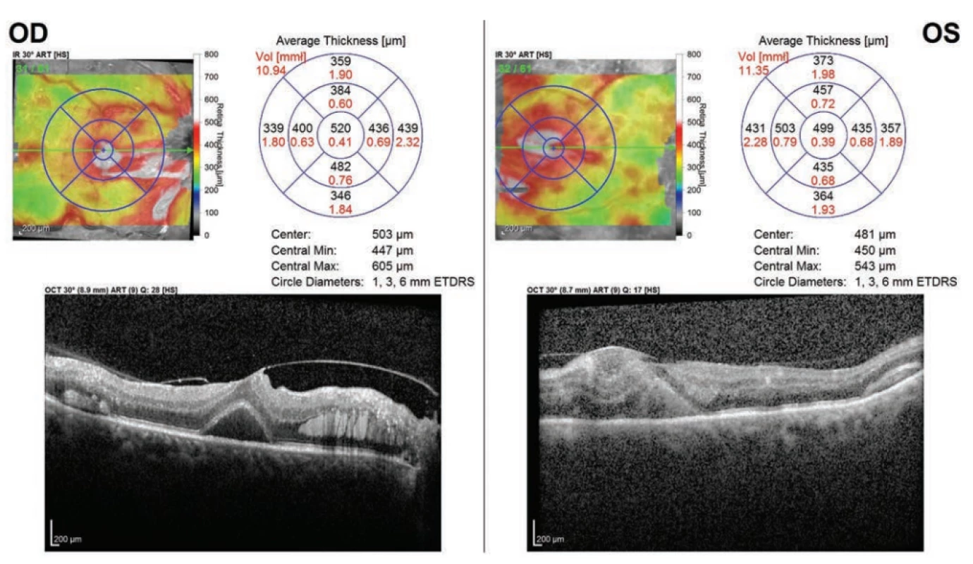 Optical coherence tomography of maculas of right and left eye – raster scan (map) and linear horizontal transfoveal scan: right eye: vitreomacular traction with ablation of foveola and intraretinal deposits, left eye: pronounced disorganisation of neuroretinal layers
