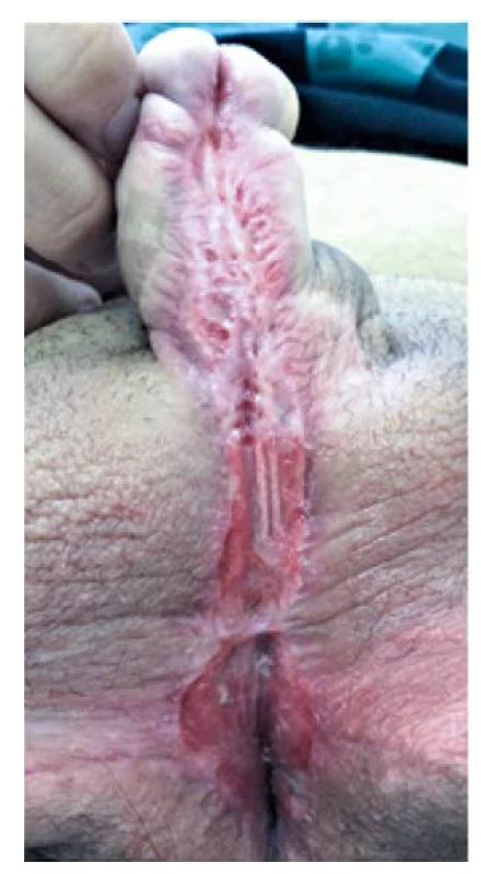 Uretrální ploténka tři měsíce po
dermatologické léčbě<br>
Fig. 3. Urethral plate three months
after dermatological treatment