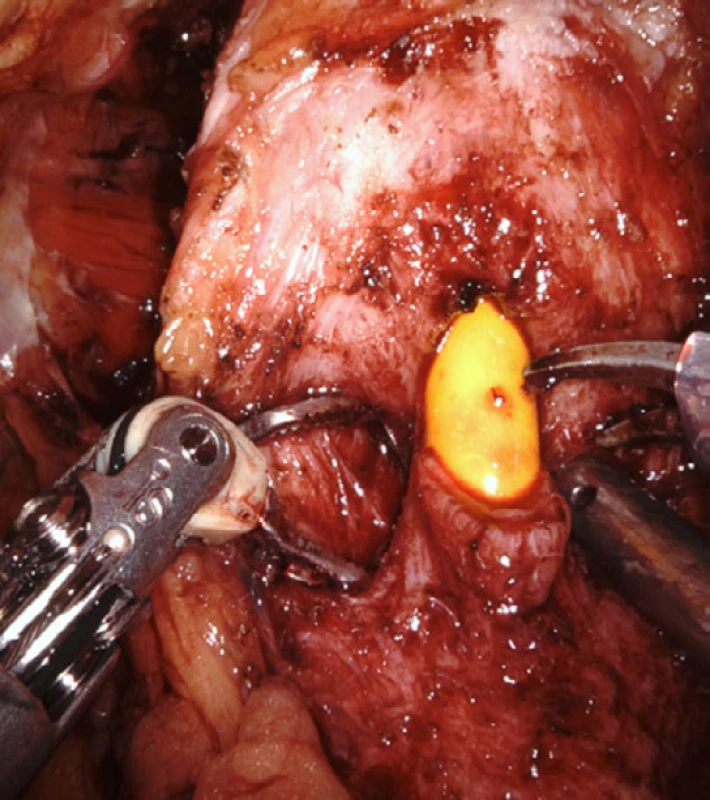 Ukazuje fázi přerušení hrdla močového měchýře
na zavedeném permanentním močovém katétru střihem
nůžek bez použité koagulace<br>
Fig. 4. The phase of bladder neck transection on an
indwelling urinary catheter using scissors with no coagulation