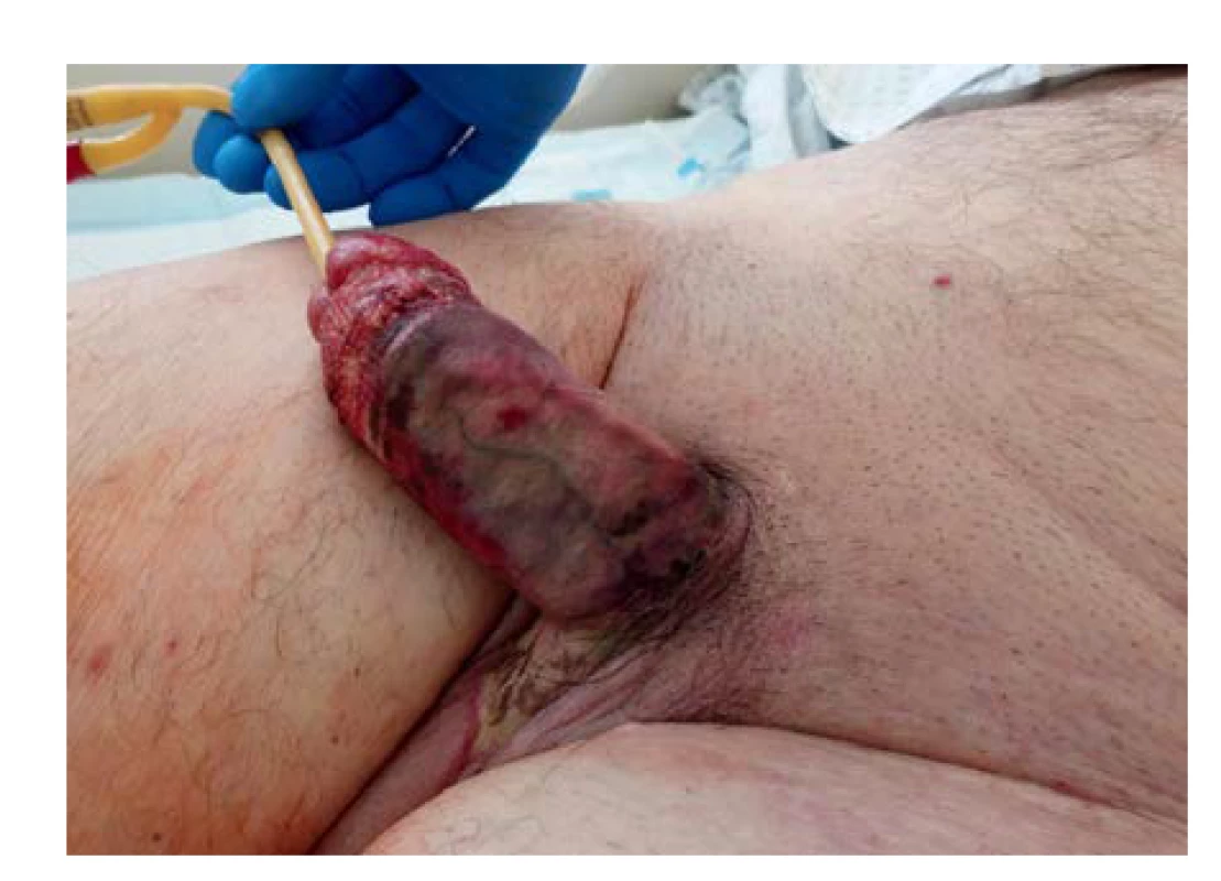 Nekróza kožního krytu penisu, předkožky i penoskrotální
oblasti společně s uretrou před nekrektomií<br>
Fig. 3. Necrosis of the penile skin, prepuce as well as the
penoscrotal region with the urethra prior to necrectomy