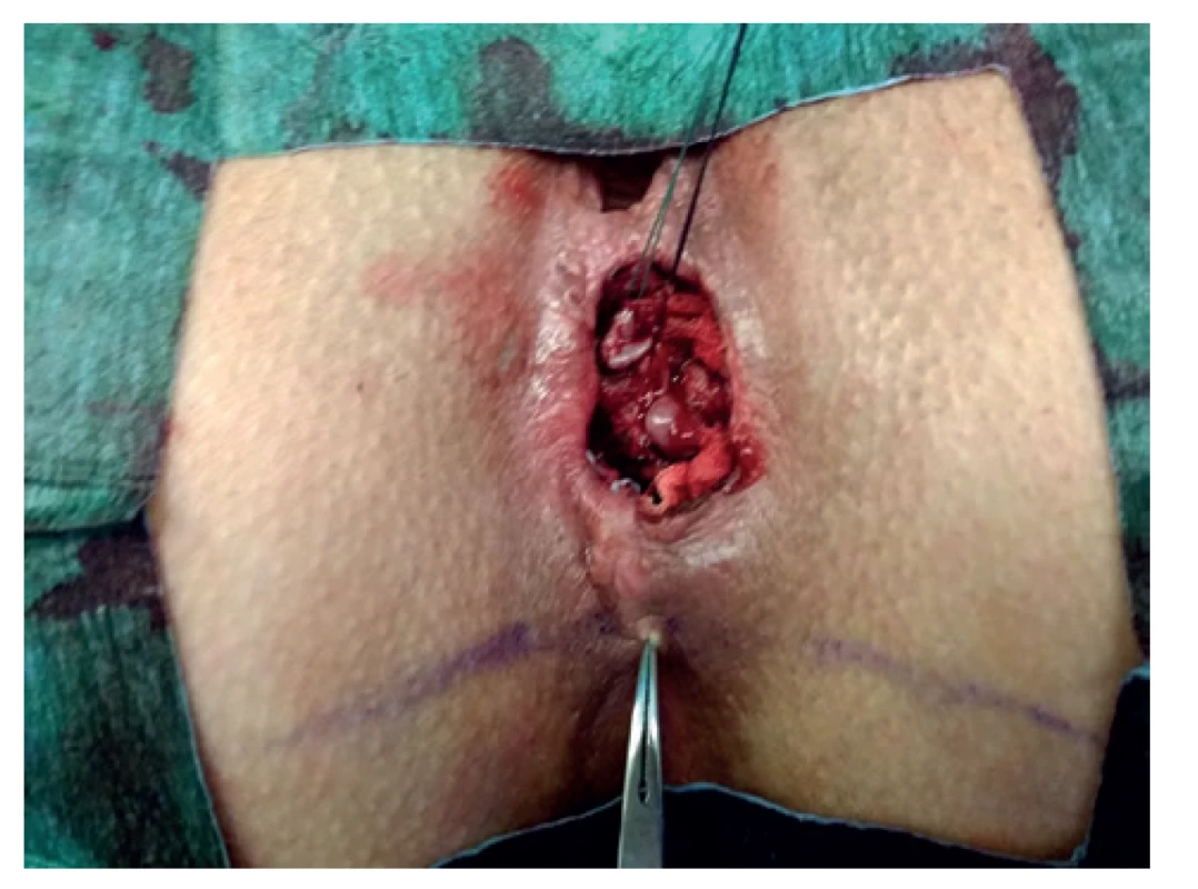 Vypreparována perineální píštěl<br>
Fig. 3: Prepared perineal fistula