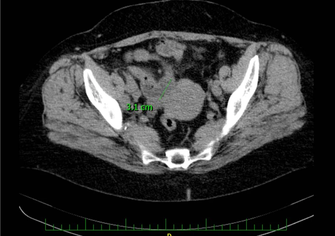 CT vyšetření zachycující intraluminální expanzi v augmentovaném močovém měchýři<br>
Fig. 4. CT examination capturing intraluminal expansion in the augmented bladder