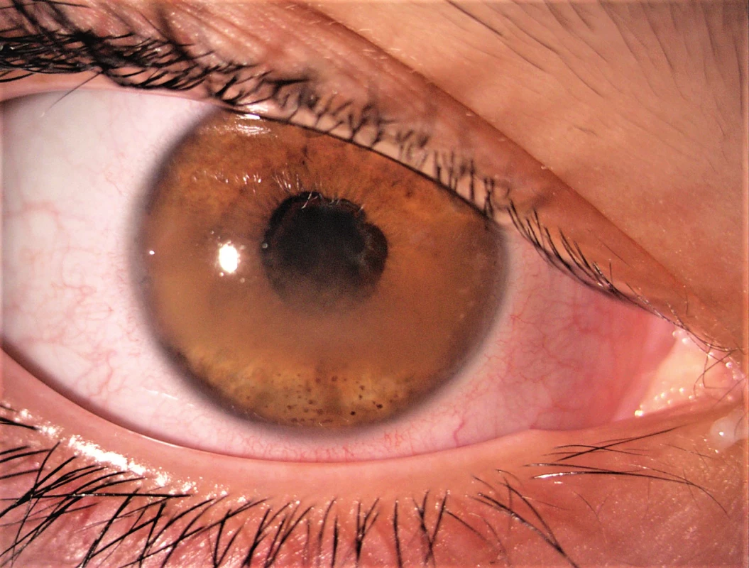 Uveitida se zonulární keratopatií, zadními synechiemi a kataraktou.<br>Fig. 1. Complicated uveitis with band kerathopathy, posterior synechiae and cataract.