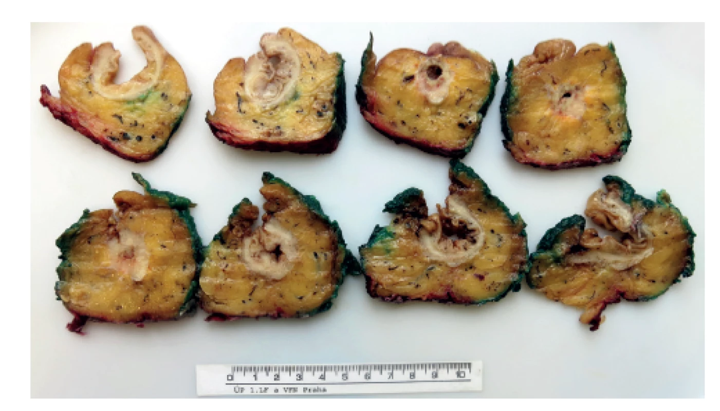 Preparát rekta s karcinomem prokrájený patologem<br>
Fig. 4: Specimen of rectum with tumor sliced by pathologist