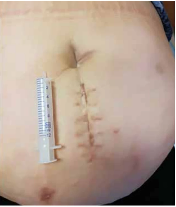 Kožní jizva 6 týdnů po HALS nefrektomii pro tumor u obézní pacientky (BMI 45,9)<br>
Fig. 4: Skin scar 6 weeks after HALS nephrectomy for renal tumor in an obese patient (BMI 45.9)