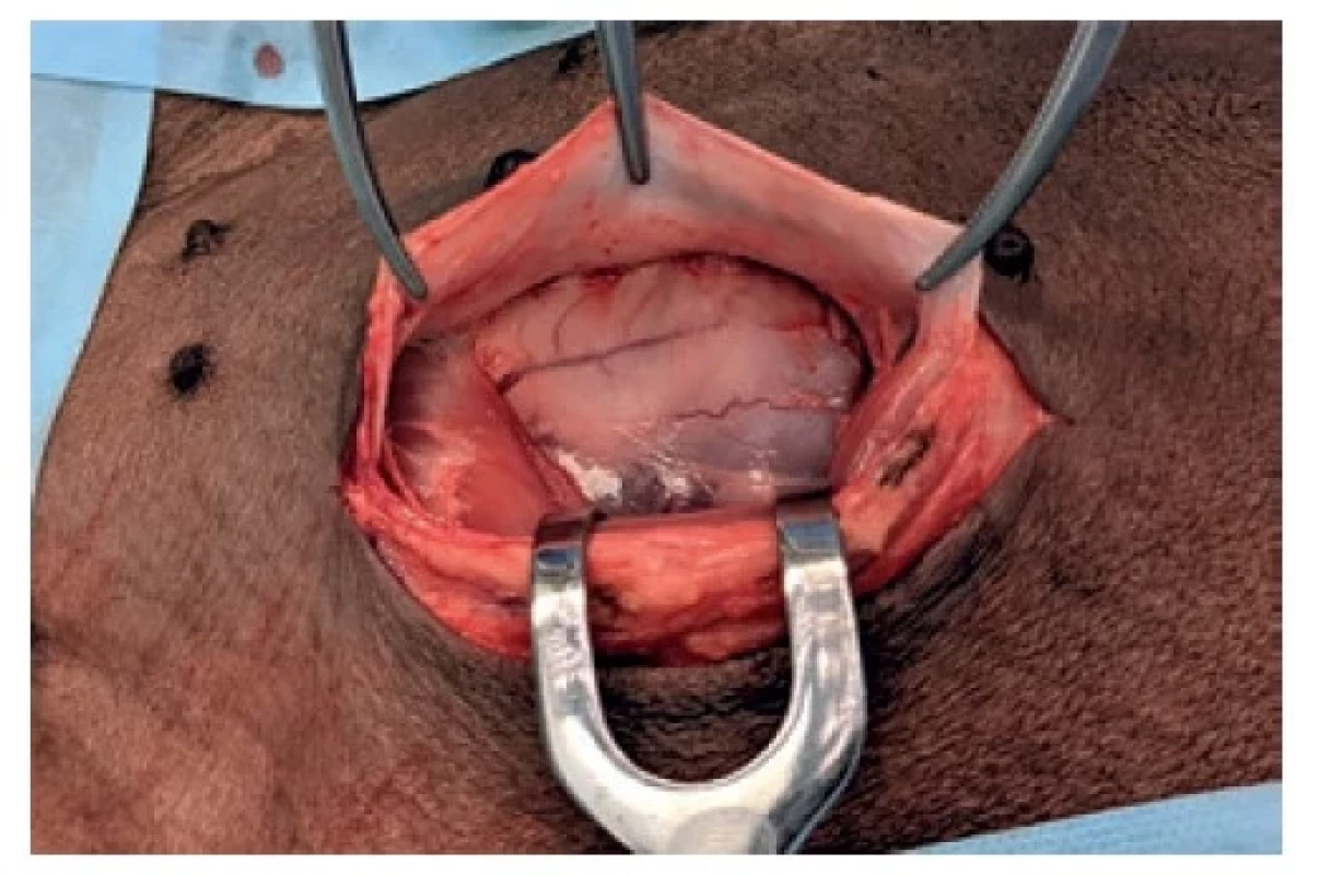 Incize, odtažený musculus rectus sinister<br>
Fig. 3: The incision; retracted left rectus muscle