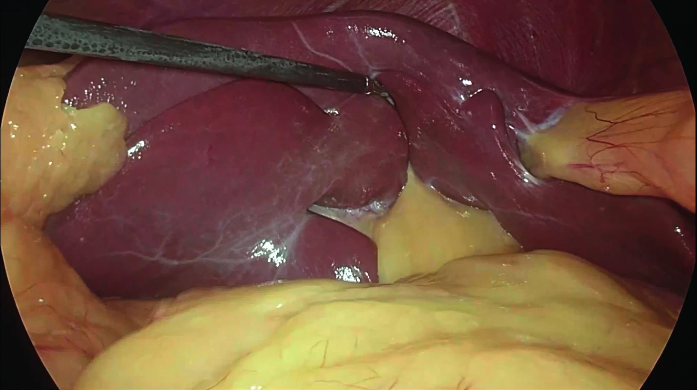 View on the liver hilum at the beginning of the laparoscopic cholecystectomy