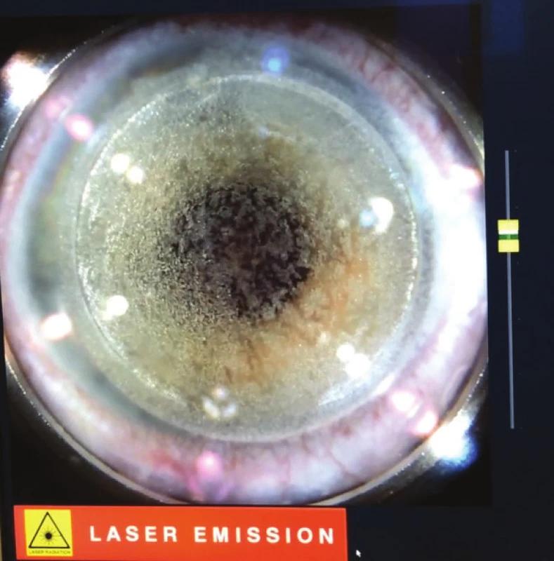 Creation of corneal flap with femtosecond laser
LenSx® (Alcon, Fort Worth, Texas, USA)