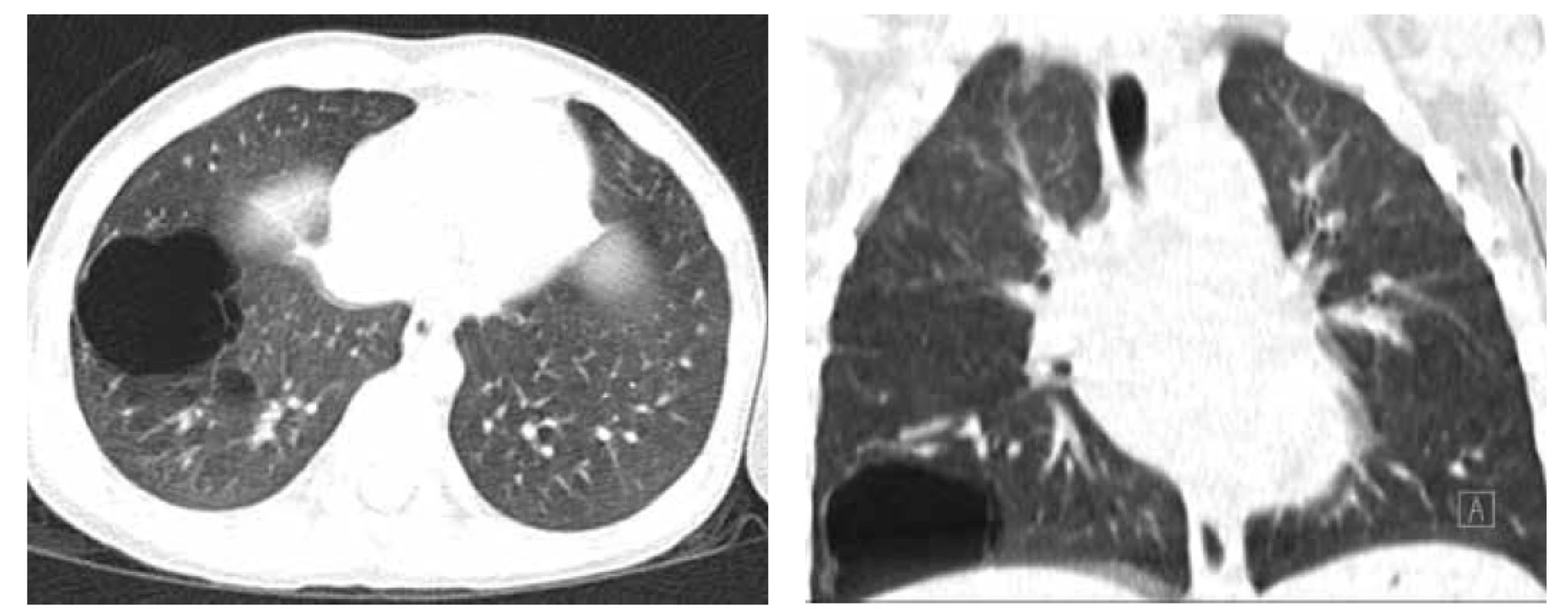 A. CT hrudníku, transverzální řez, asymptomatická CPAM PDL, prenatálně diagnostikovaná.<br>
Fig. 2A. Chest CT scan, transversal cut, asymptomatic CPAM in right lower lobe, diagnosed prenatally.<br>
Obr. 2B. CT hrudníku, koronární řez.<br>
Fig. 2B. Chest CT scan, coronary cut.