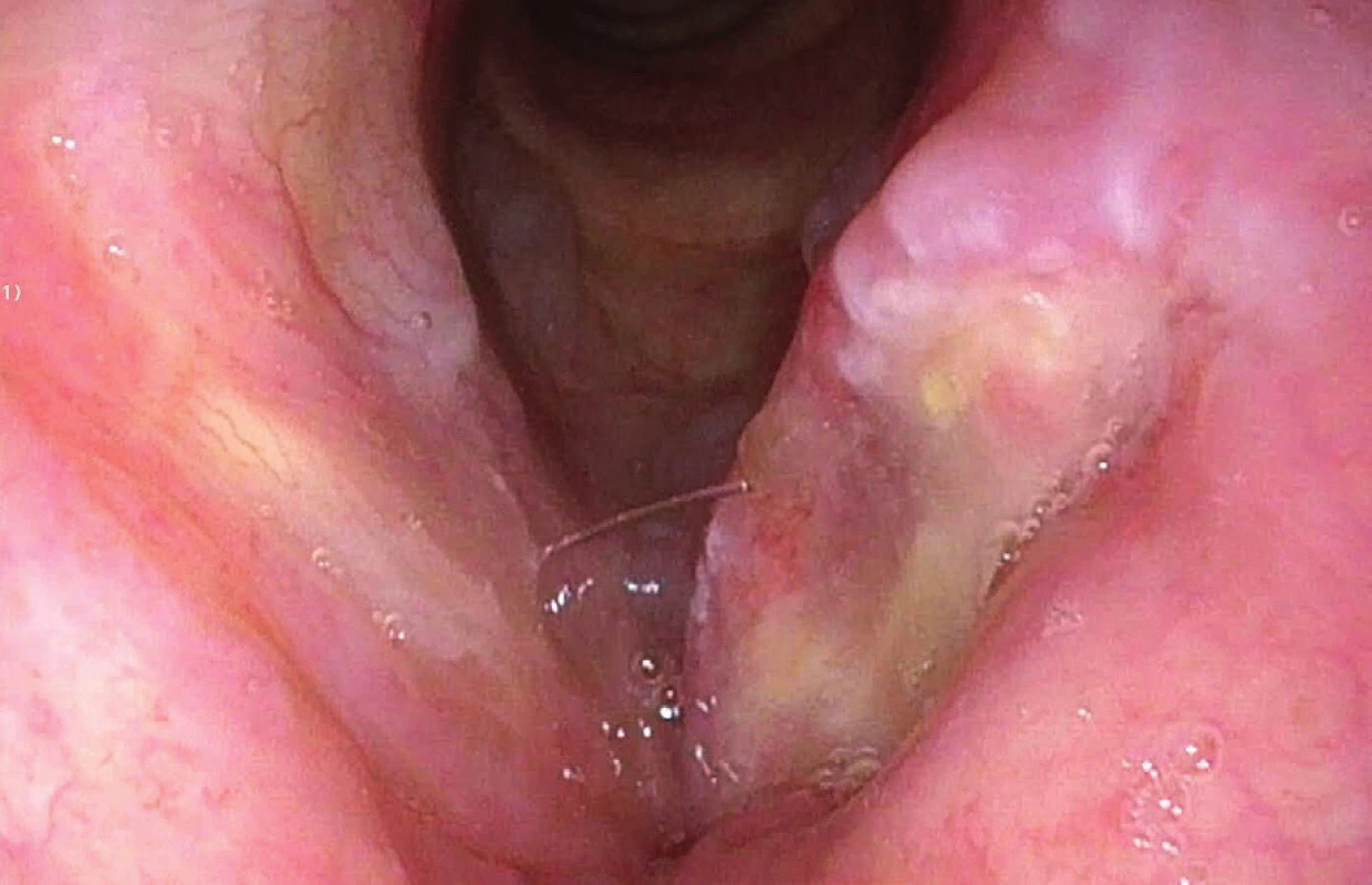 Endoskopické vyšetření v bílém světle – spinocelulární
karcinom levé hlasivky