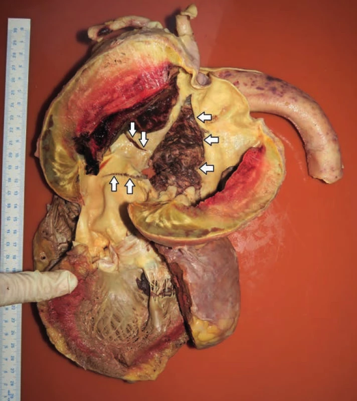 The view of the left ventricular outflow tract, ascending aorta and aortic
arch showing chronic dissection with intramural hematoma and isolated
defects in the aorta’s wall. Defect no. 1 (arrows pointing upwards). Defect no.
2 (arrows pointing downwards). Defect no. 3 (arrows pointing to the left).