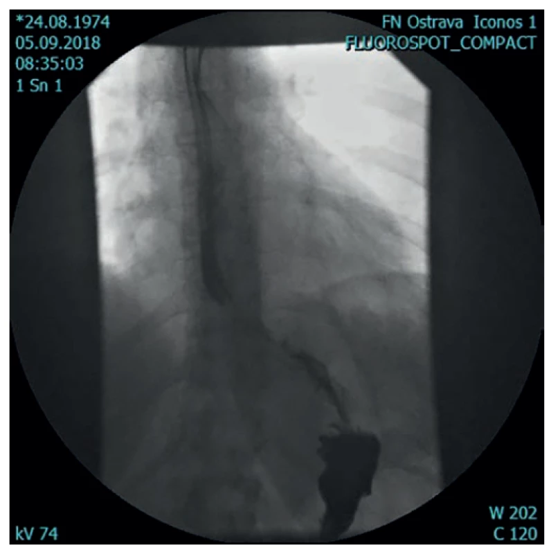 Po operaci (reparována hiátová hernie a parciální
fundoplikace<br>
Fig. 2. Post-operative status (hiatal hernia repair and
partial fundoplication)