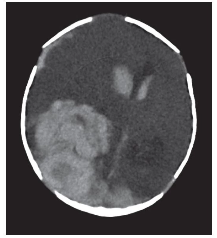 Kazuistika 2, vstupní CT: objemný intraparenchymový
hematom parietookcipitálně vpravo s provalením do komor, posun
středočárových struktur vlevo, tentoriální konus vpravo