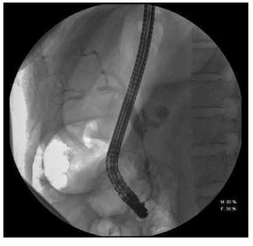 Rtg snímek stenózy choledochu při autoimunitní pankreatitidě
pořízený během vyšetření ERCP našeho pacienta