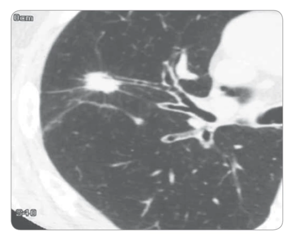 Výpočetní tomografie – sken karcinomu plic.