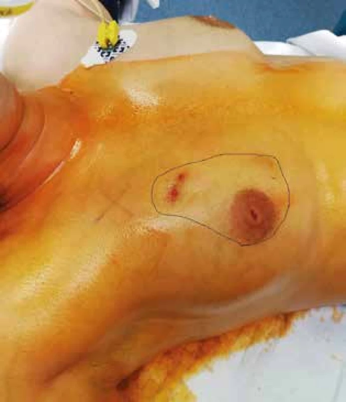 Předoperační označení rozsahu resekce prsu s GM <br>
Fig. 1: Preoperative marking for breast resection due to GM