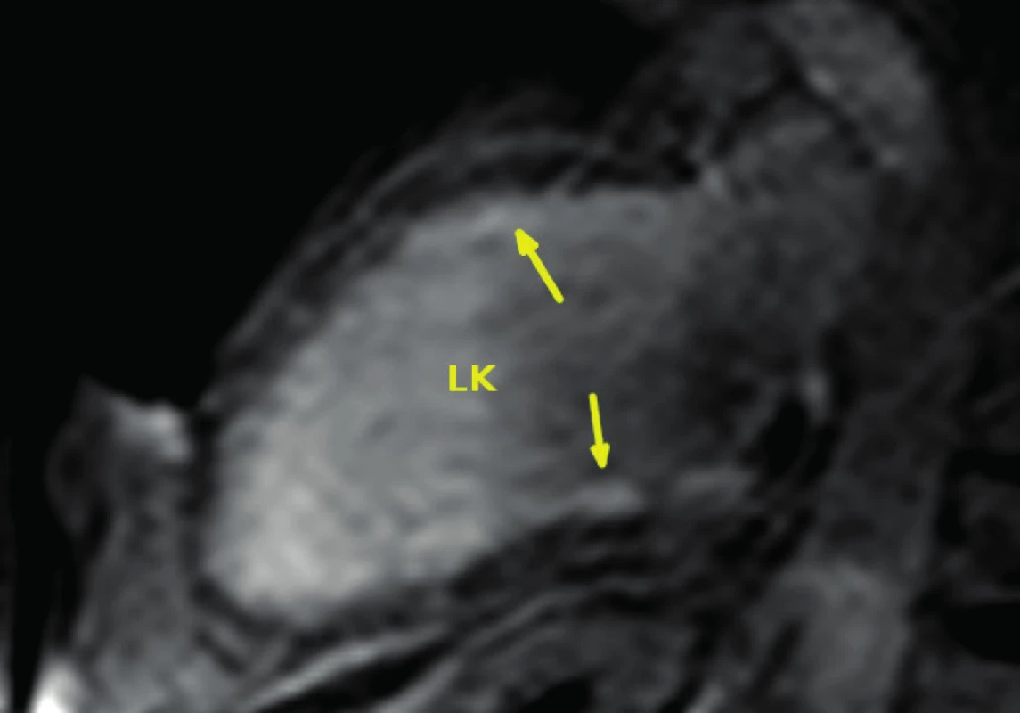Obraz eozinofilní myokarditidy při vyšetření magnetickou rezonancí
v horizontální dlouhé ose: šipky označují hypersignální lem difuzního subendokardiálního pozdního sycení kontrastní látkou v oblasti levé komory
(LK – levá komora)