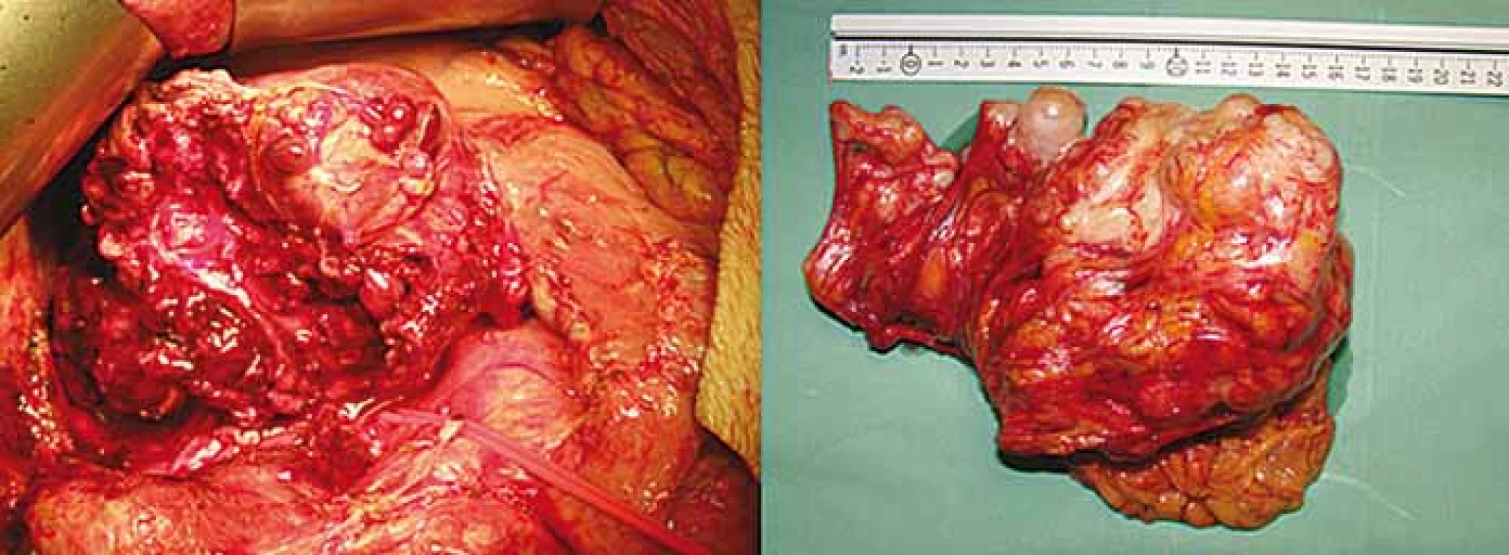 A. Intraoperative photo showing gastrointestinal stromal tumor and diaphragmatic
crus. 3B. Specimen after proximal gastrectomy showing “en-block” tumor and
esophago-gastric junction.