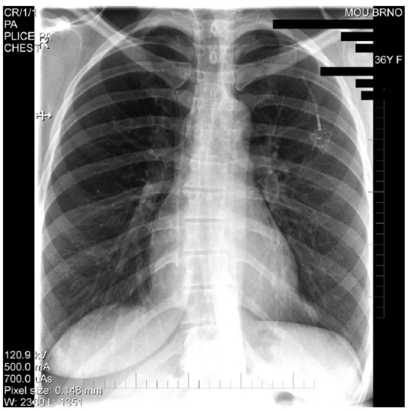 RTG hrudníku – Obraz kompletní ruptury katetru
portu (pinch-off)<br>
Fig. 4. Chest X-rays – Complete rupture of the port catheter
(pinch-off)