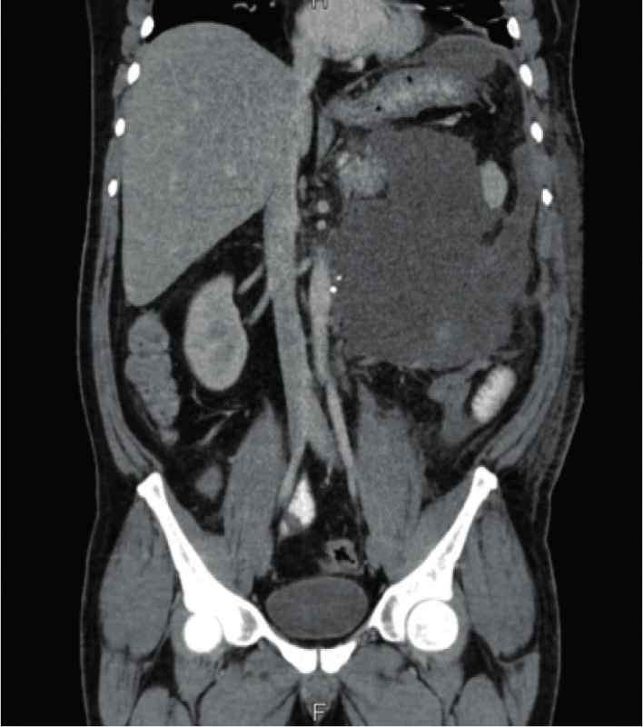CT nález peripankreatické tekutinové kolekce
pooperačně<br>
Fig. 2. CT finding of the peripancreatic fluid collection after surgery