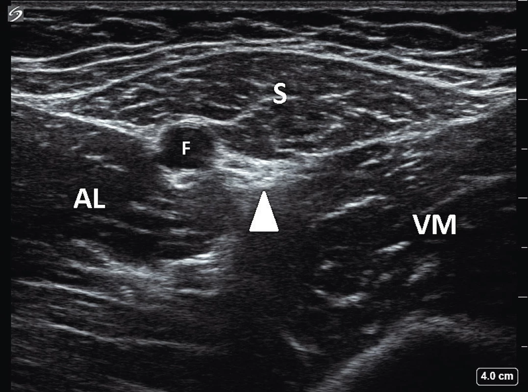 Ultrazvukový obraz stehna LDK v oblasti femorálního
trojúhelníku: S – m. sartorius, AL – m. adductor longus, VM – m.
vastus medialis, F – femorální tepna, bílý trojúhelník označuje
interfasciální prostor, ve kterém jsou nervus saphenus a nervus
vastus medialis