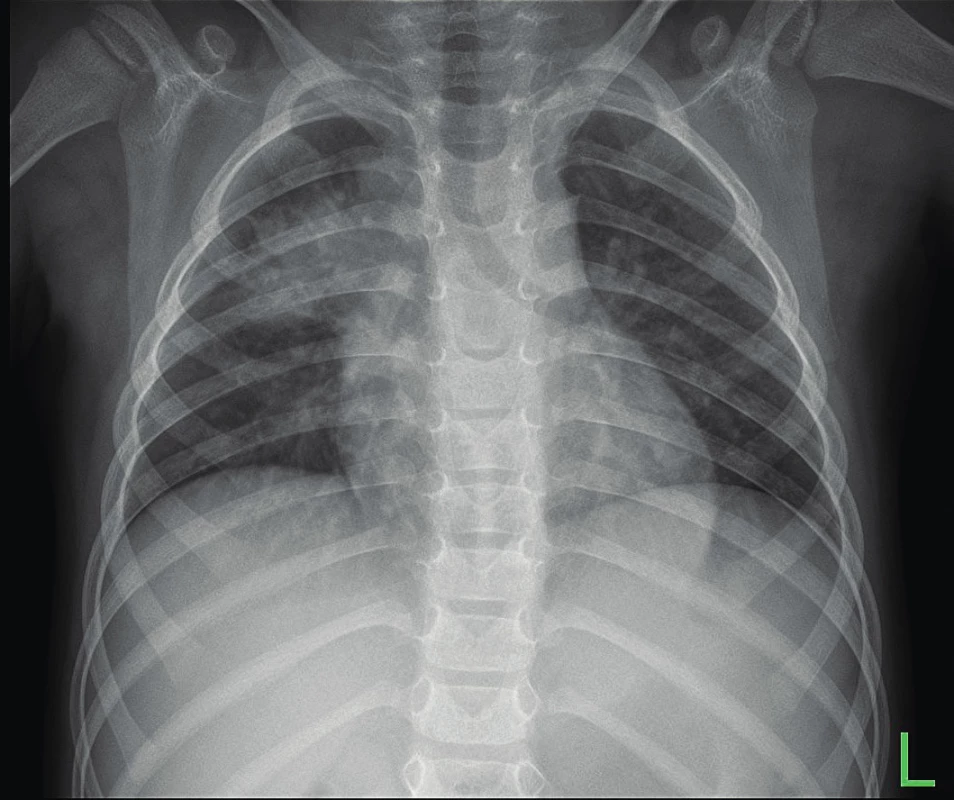a. Polyrezistentní tuberkulóza u tříletého chlapce. SKG
hrudníku před léčbou.<br>
Fig. 1a. Three years old boy with polyresistant TB. Chest X-ray
before therapy.