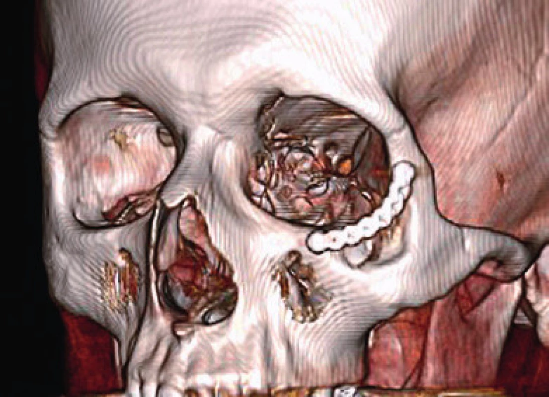 Three-dimensional CT scan after 5 months from the
surgery. The postoperative defect of the zygoma bridged with the
titanium miniplate is visible in the scan