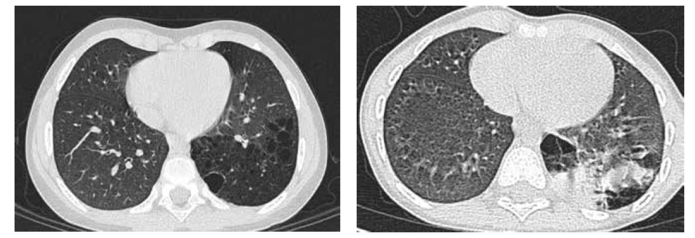 A. CT hrudníku, transverzální řez, CPAM typu 1 v LDL.<br>
Fig. 4A. Chest CT scan, transversal cut, CPAM type 1 in left lower lobe.<br>
Obr. 4B. CT hrudníku, transverzální řez, pneumonie LDL v CPAM.<br>
Fig. 4B. Chest CT scan, transversal cut, pneumonia in CPAM in left lower lobe.