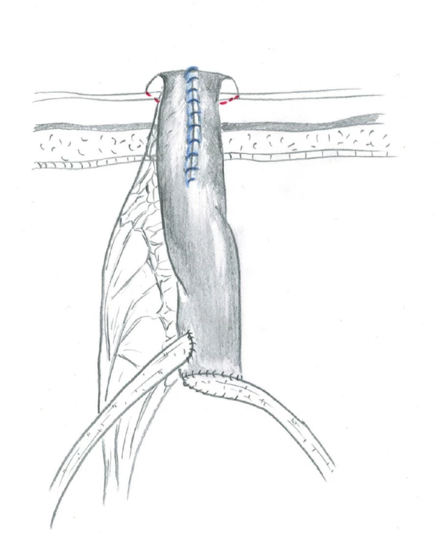 Retubularizovaná část neoveziky je využita
k vytvoření stomie<br>
Fig. 5. The retubularized part of neobladder is used for
the creation of stoma