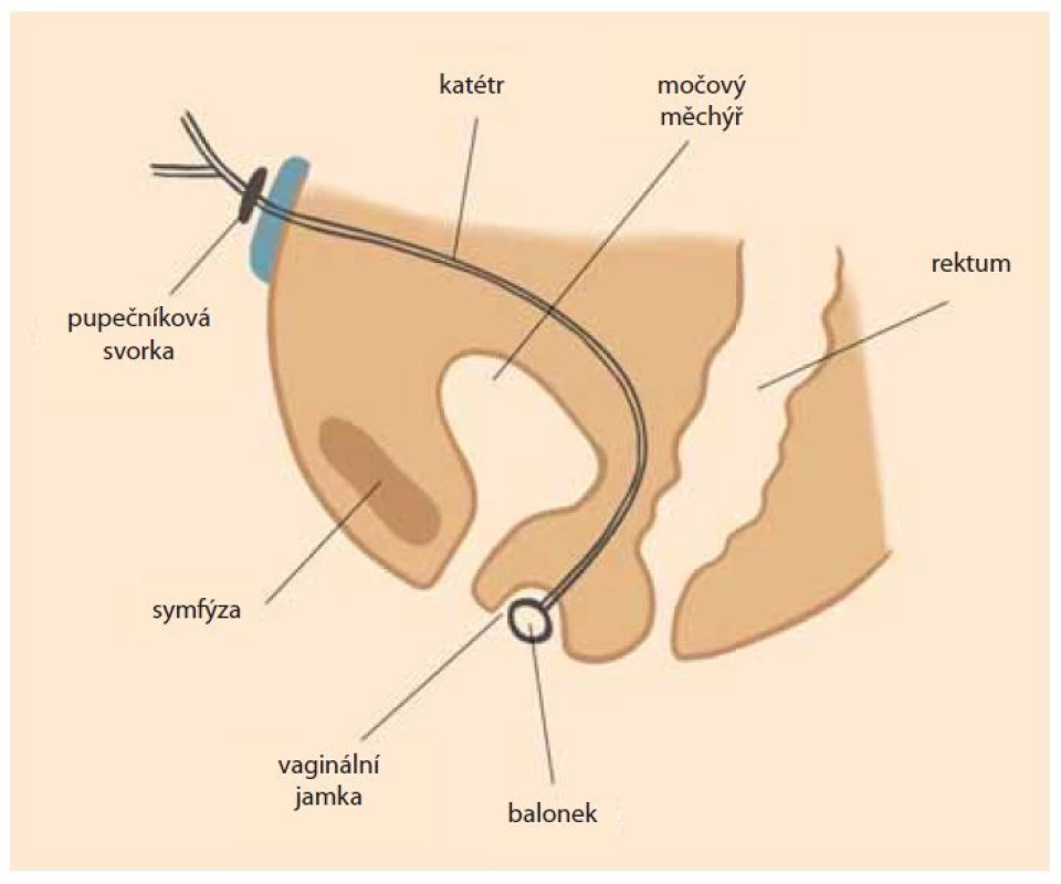 Laparoskopicky asistovaná balonková vaginoplastika.<br>
Fig. 1. Laparoscopically assisted balloon vaginoplasty.