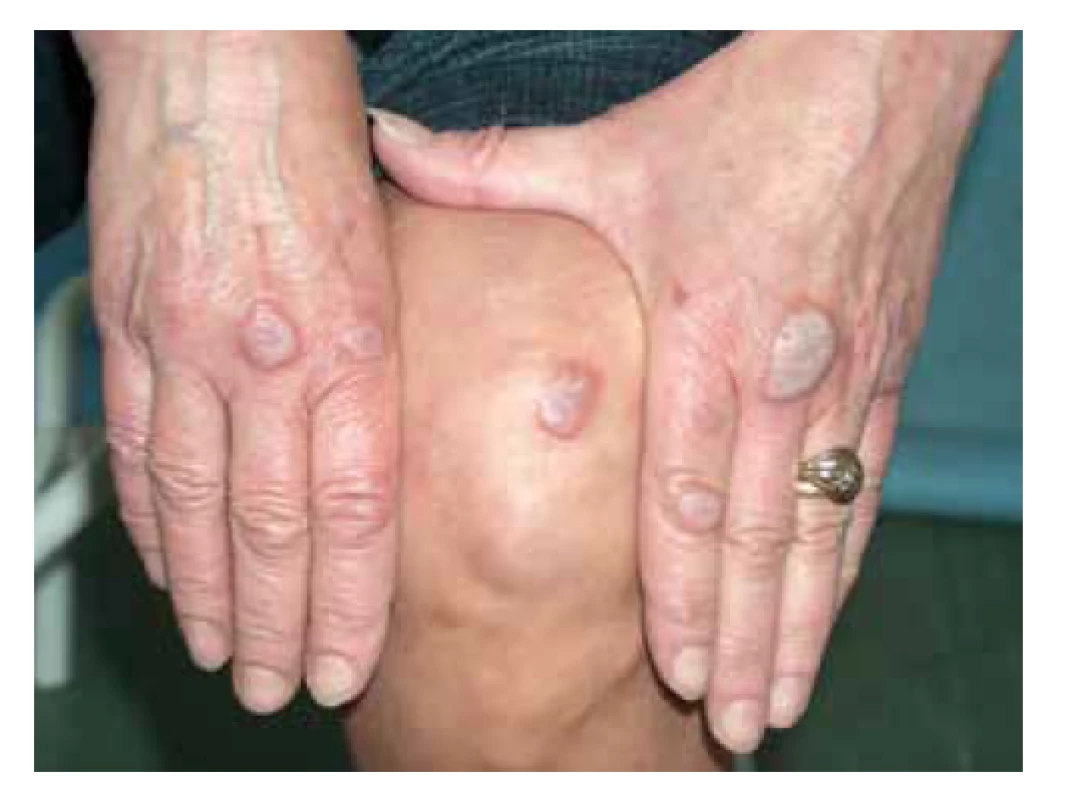 Lividní infiltrované noduly nad klouby rukou
a nad kolenem, postižení u pacientky s erythema elevatum
diutinum