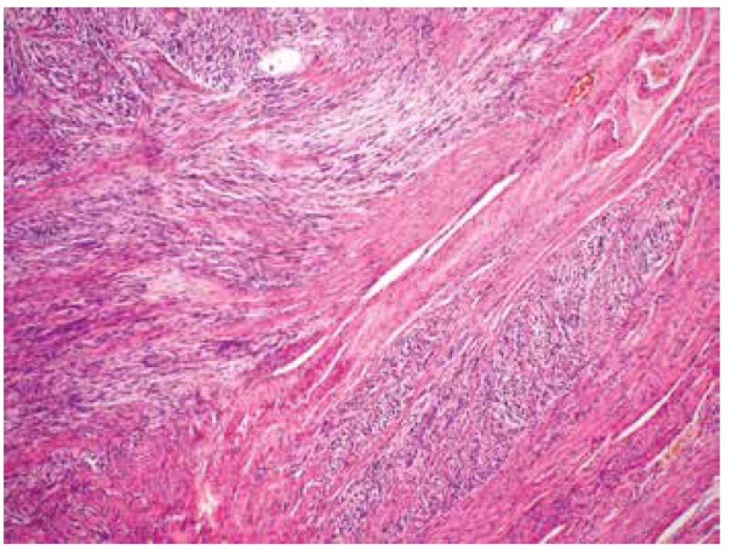 Invaze fascikulárně uspořádaného tumoru mezi snopce okolního
myometria (HE, 100x).