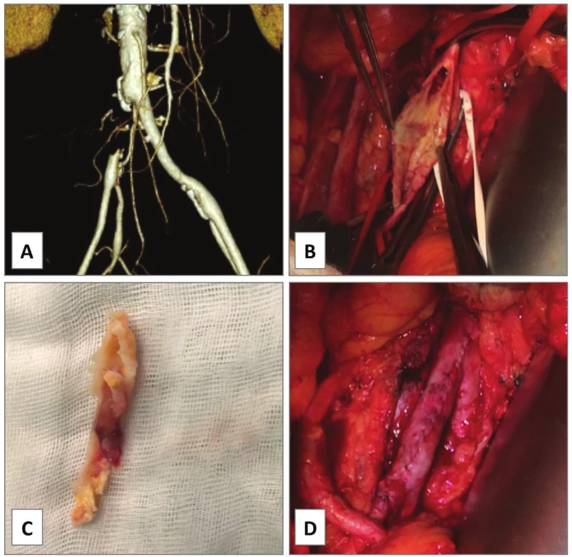 Endarterectomy of isolated occlusion of common
iliac artery, case 6