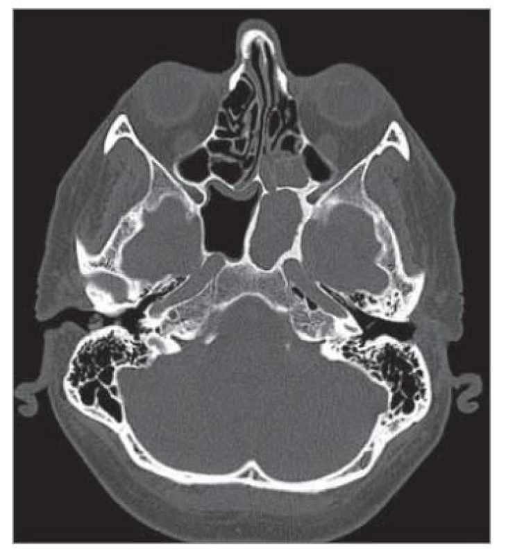 Sklerotické hyperostotické
ohraničení sfenoidálního sinu vlevo.
Nativní CT, kostní okno, axiální
rovina.<br>
Fig. 1. Sclerotic hyperostotic border
of the left sphenoid sinus. Native CT,
bone window, axial plane.