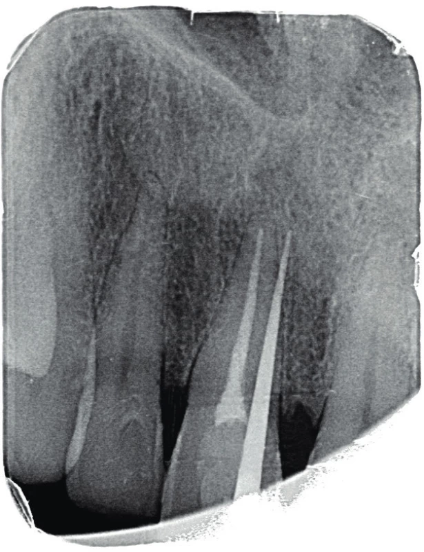 Fistulografie
horního frotálního
úseku. Zavedený
gutaperčový čep ve
fistule směřuje meziálně
od apexu
zubu 11 do místa periapikálního
projasnění
