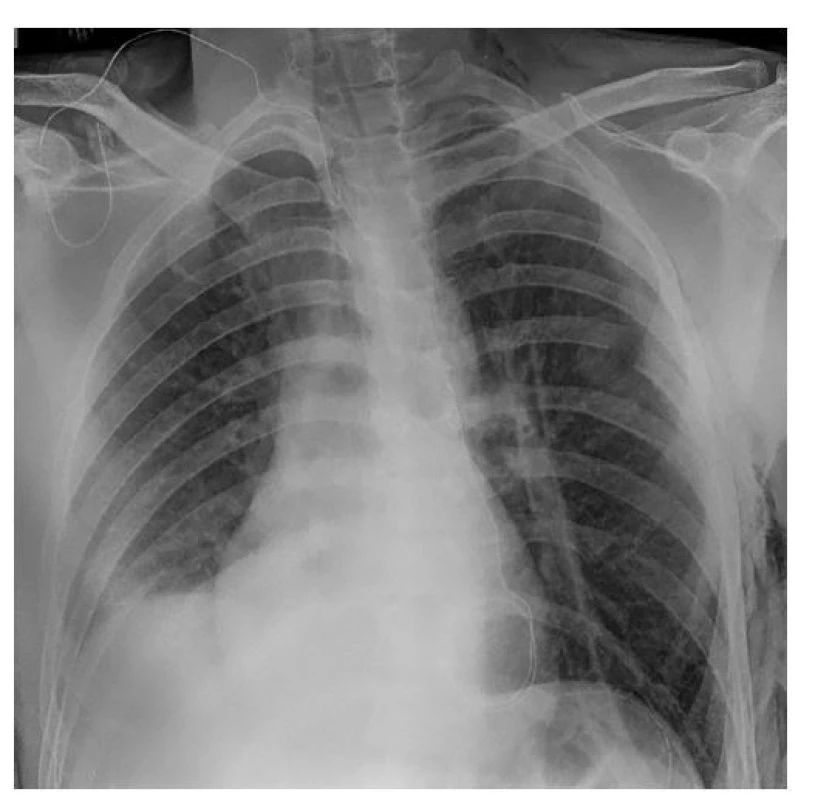 Pooperační RTG snímek<br>
Fig. 2: Postoperative X-ray scan