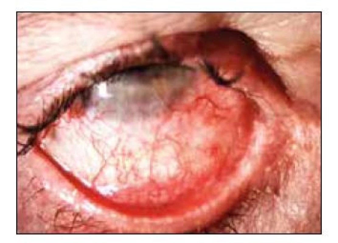 Oční jizevnatý pemfigoid (OCP) – typické
hyperemie, jizvení spojivky, změlčení fornixů
a symblefaron. [Foto: archiv autorky]