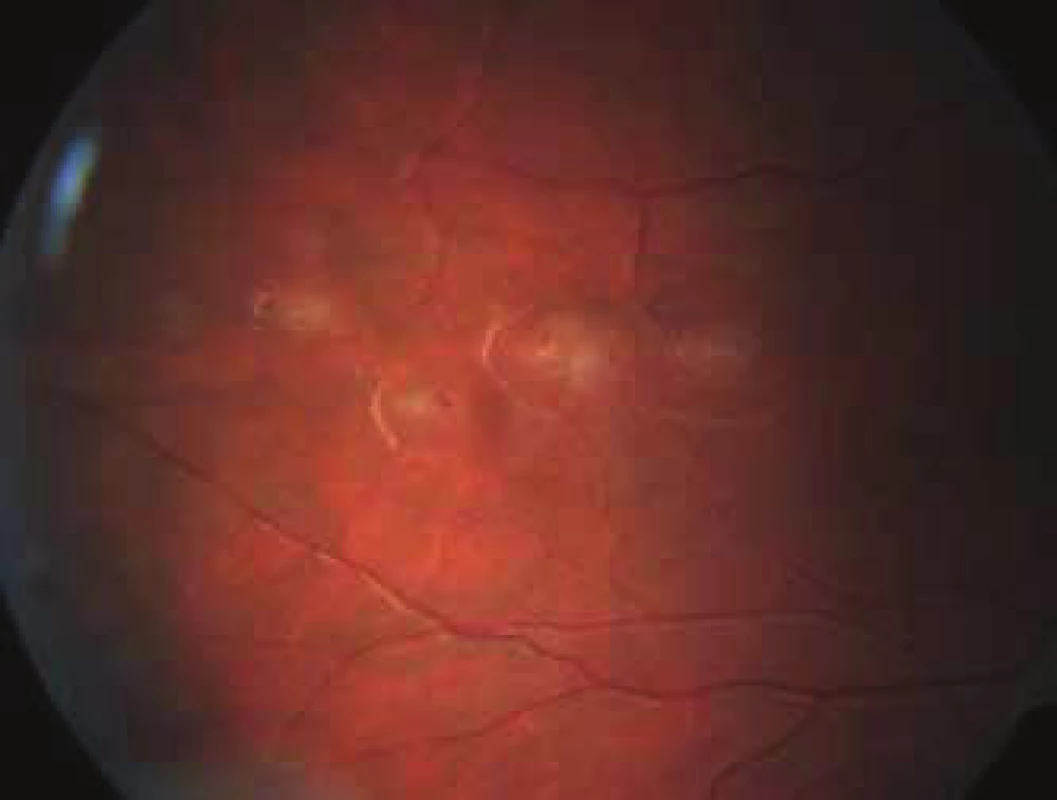 Leukaemic infiltrates of retina