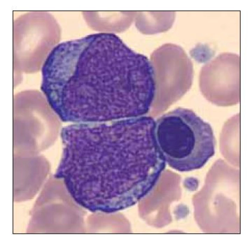 Dvě blastické buňky
a ortochromní normoblast.