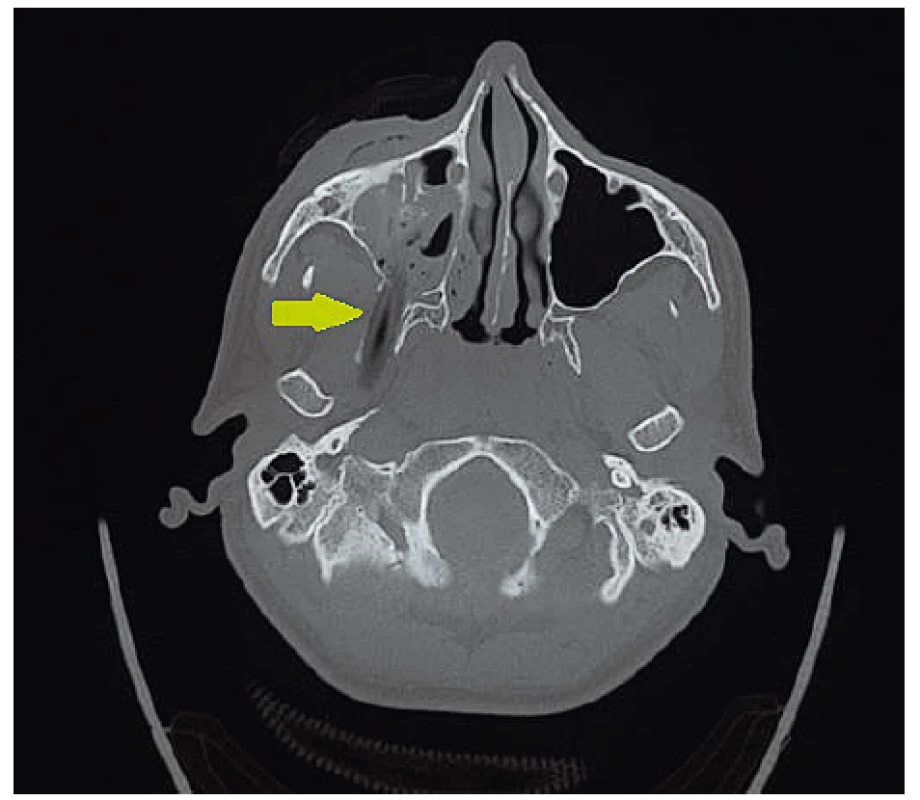 Cudzie teleso označené šípkou na transverzálnom CT
reze.